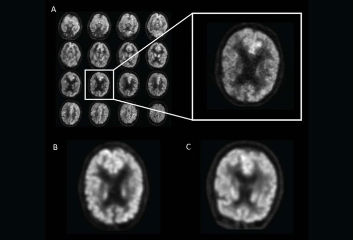 Obrázek: Umělá inteligence umí odhalit Alzheimera roky před lékaři