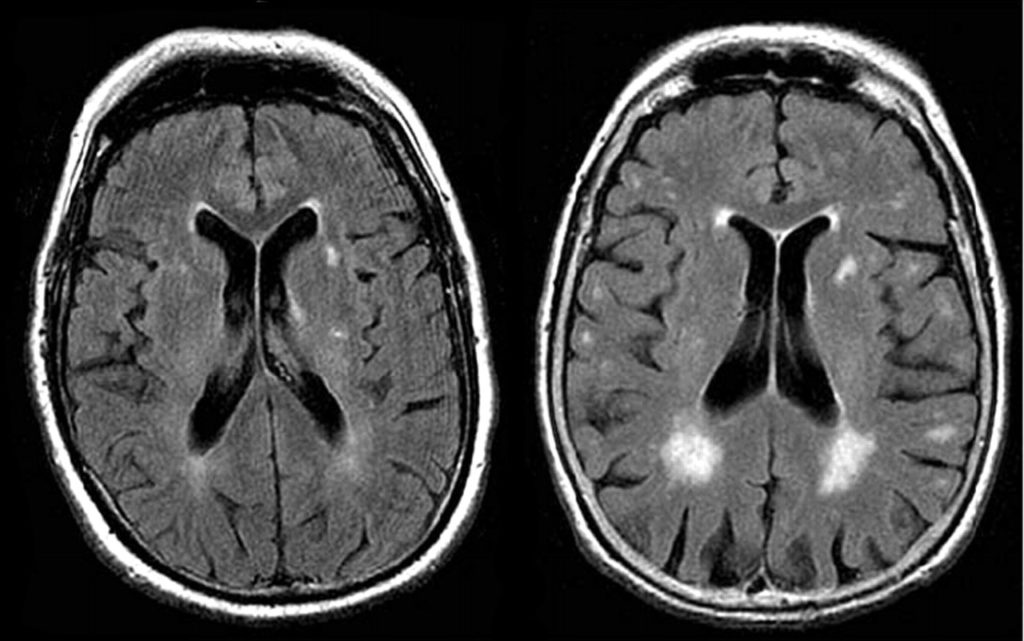 Obrázek: Umělá inteligence umí odhalit Alzheimera roky před lékaři